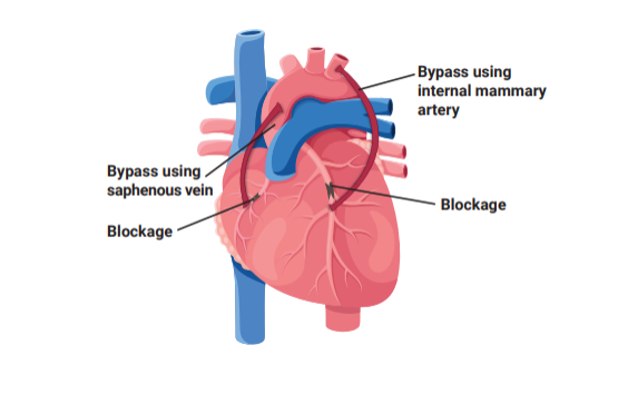 CABG