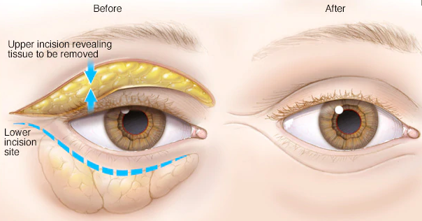 Blepharoplasty Eyelid Lift (Both Lids)