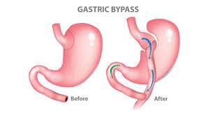 Gastric Bypass, Singapore