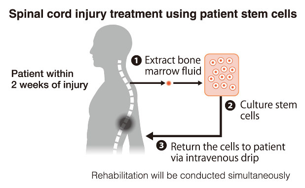 Stem Cell therapy for Spinal Cord Injuries
