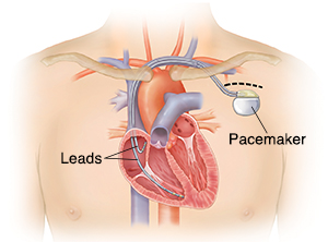 Permanent Pacemaker Implantation, India