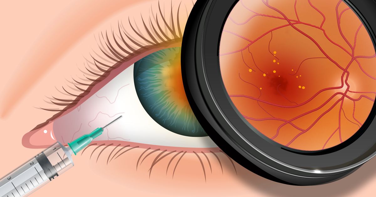 VITREO RETINAL PROCEDURES Intravitreal Injection antibiotics for Single Eye