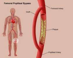 Popliteal Bypass or Extra Anatomic Bypass