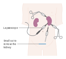 Nephrectomy Partial Laparoscopic