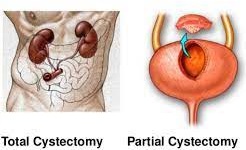 Cystectomy Partial