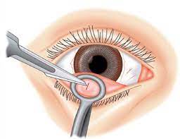 ORBIT AND OCULOPLASTY Chalazion Incision & Curettage Surgery Single Eye