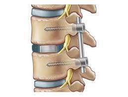 2 Level TLIF Spine Surgery
