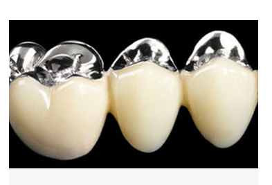 Tooth crown metal ceramic