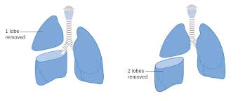 Lobecotomy or Bilobectomy Pulmonary