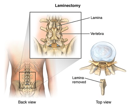 Lumbar Laminectomy for Spine, Thailand