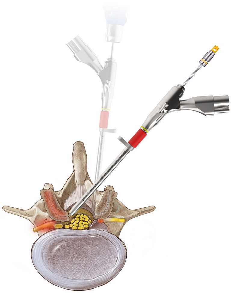 Minimally Invasive Spine Endoportal Endomicroscopic Canal Decompression