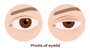 ORBIT AND OCULOPLASTY-Ptosis Surgery with Fasanella Servat Procedure- Single Eye