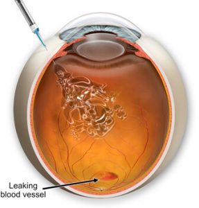 VITREO RETINAL PROCEDURES Intravitreal Injection Eyelea Single Eye