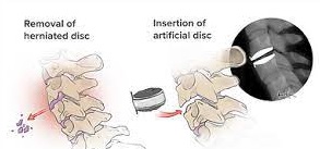 Total Cervical Disc Replacement-Spine, Singapore
