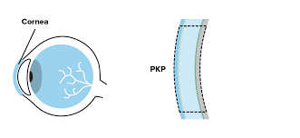 CORNEAL AND OCULAR SP-Penetrating Keratoplasty- Single Eye