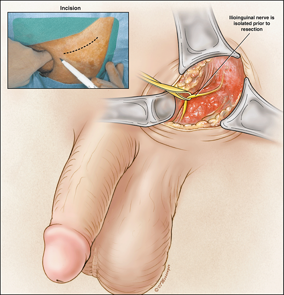Microsurgical Cord Denervation For Chronic Scrotal Pain