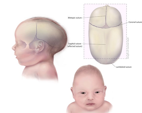 Developmental Craniosynostosis