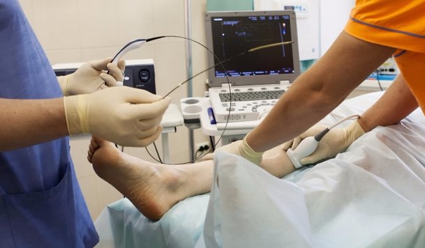 Varicose Veins Double Laser or RFA