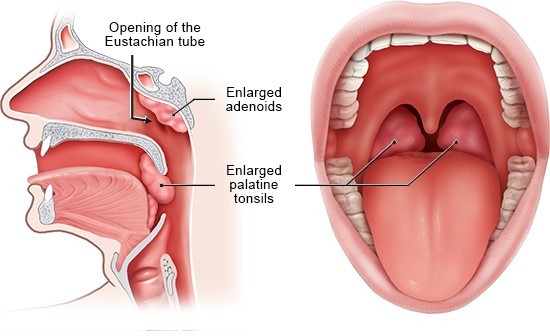 Adenoid and tonsil hypertrophy or infections