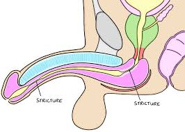 Stricture Urethra or Urethroplasty Traumatic End To End, India