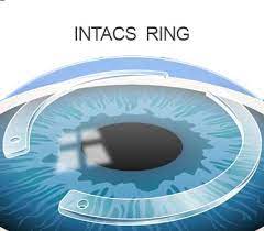 Femto Laser Assisted Intacs Ring for Keratoconus