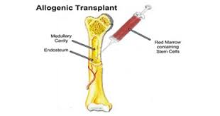 Bone Marrow Transplant Allogenic, Thailand