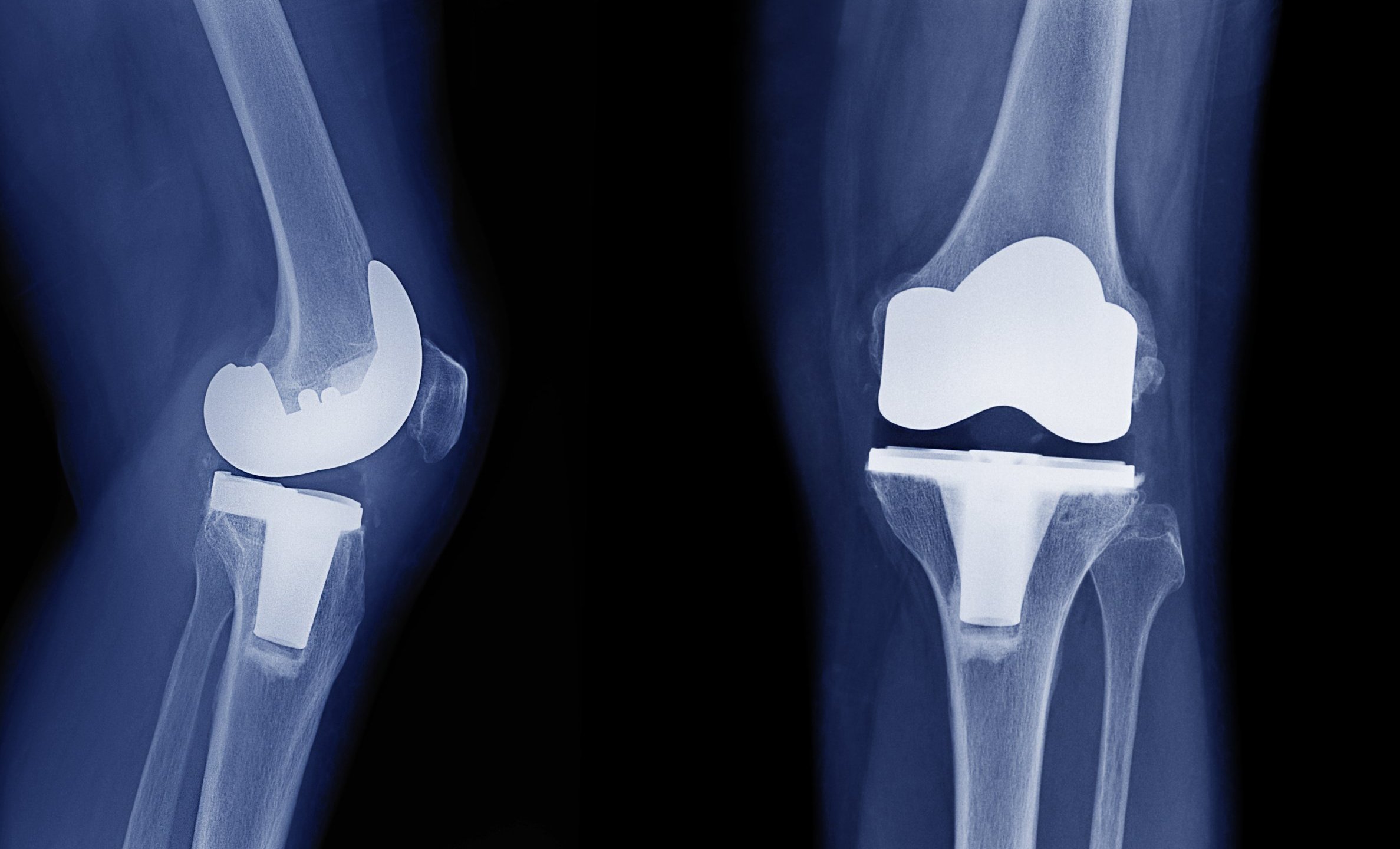 Total Knee Replacement BL, Singapore