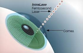 CORNEAL AND OCULAR SURFACE PROCEDURES-Intralase (Femtosecond laser) application- Single Eye