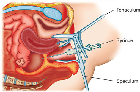 Drainage Of Pelvic Abscess or Colpotomy