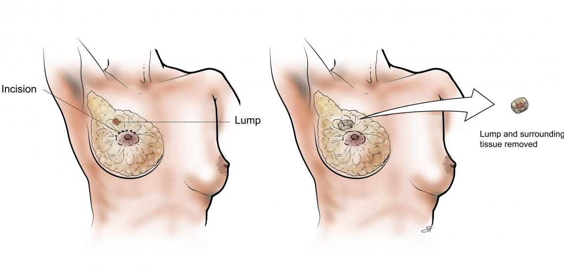 Breast Lumpectomy Under Ga