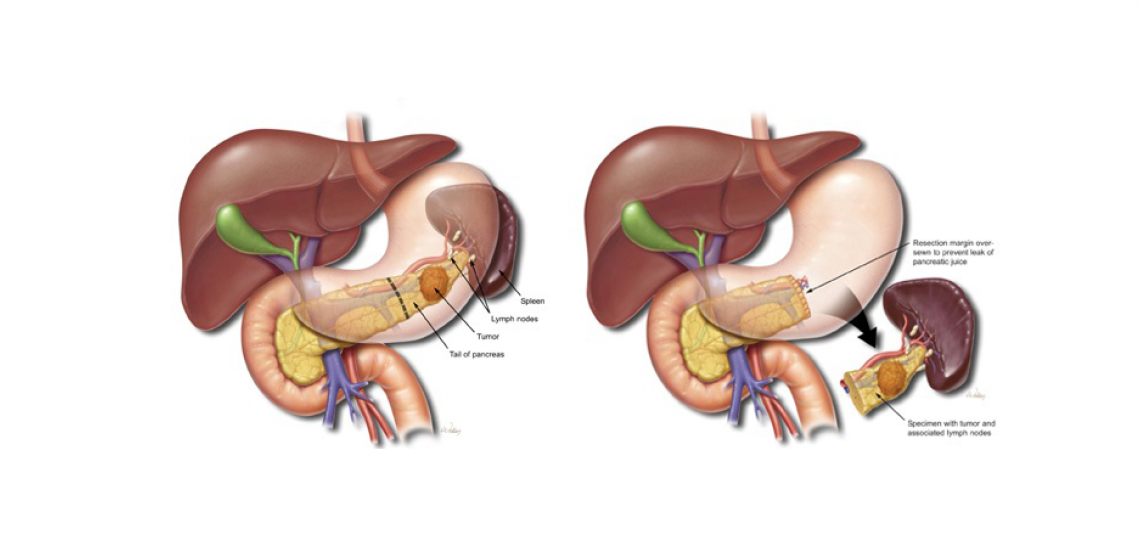 Pancreatectomy Distal and Splenectomy Oncosurgery