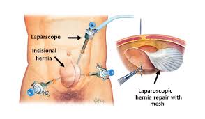 Incisional Hernia Repair With Or Without Mesh