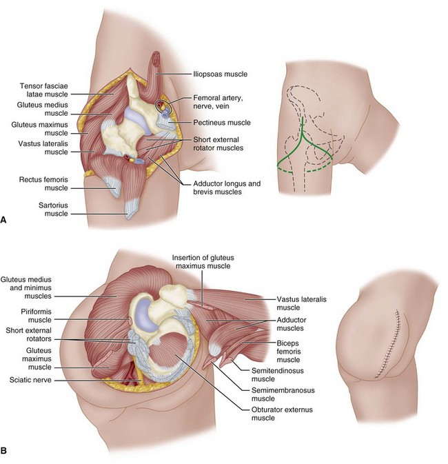 Disarticulation Hip Oncosurgery