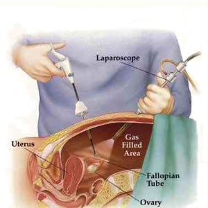 Hysterectomy LAVH