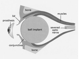 ORBIT AND OCULOPLASTY Evisceration with ball implant Single Eye