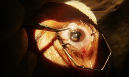 CATARACT MICS with trifocal PCIOL Single Eye