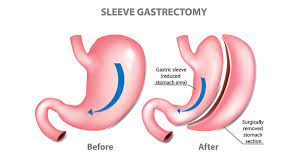 Sleeve Gastrectomy, India