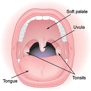 Tonsillectomy, Thailand