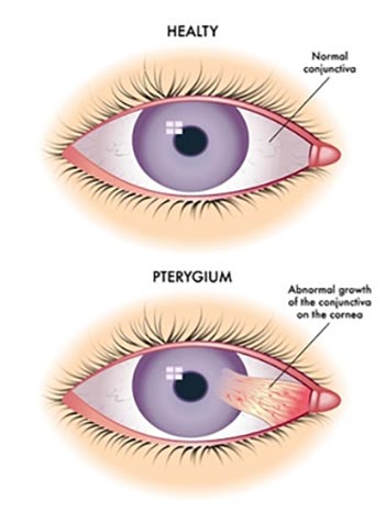 Pterygium excision- Single Eye