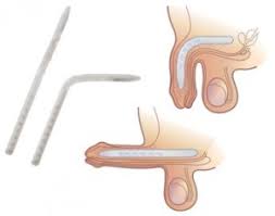 Erectile Dysfunction Semi Rigid Penile Implant or Prosthesis