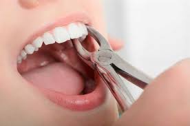 Non Surgical Tooth Extraction