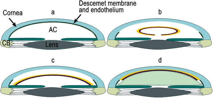 CORNEAL AND OCULAR SURFACE PROCEDURES-DSAEK- Descemet's Stripping Automated endothelial keratoplasty