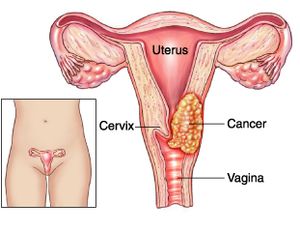 Cervical Cancer Treatment, Thailand