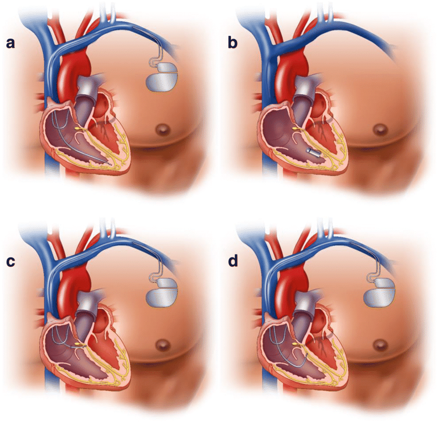 Pacemaker Procedure Double Chamber
