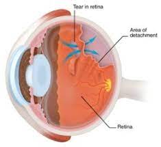 VITREO RETINAL PROCEDURES Retinal detatchment Surgery or Scleral Buckling Single Eye