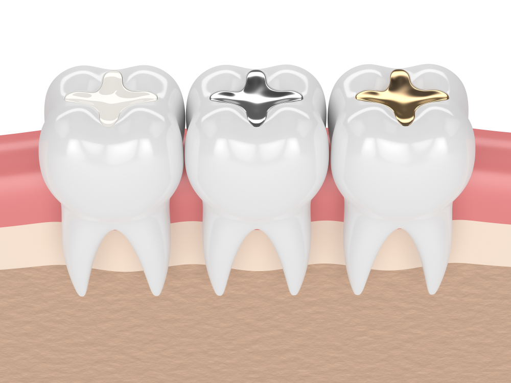TOOTH CAVITY COMPOSITE FILLING
