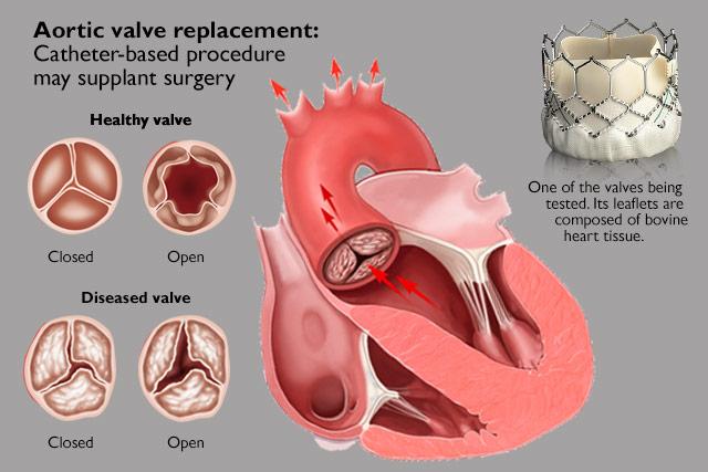 Aortic Valve Replacement, Canada