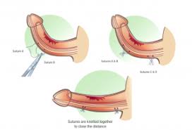 Penile Curvature Surgery