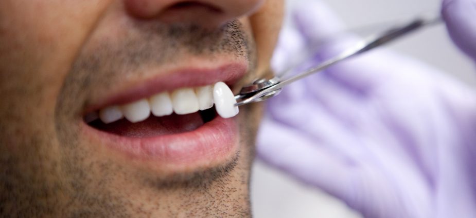 Smile Design Procedure Porcelain Veneers Per Tooth