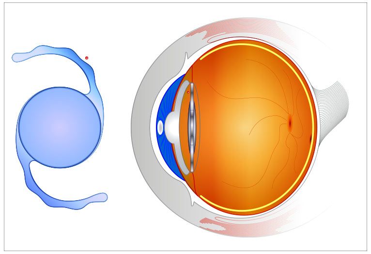 CATARACT MICS with Non Aspheric Monofocal PCIOL Single Eye